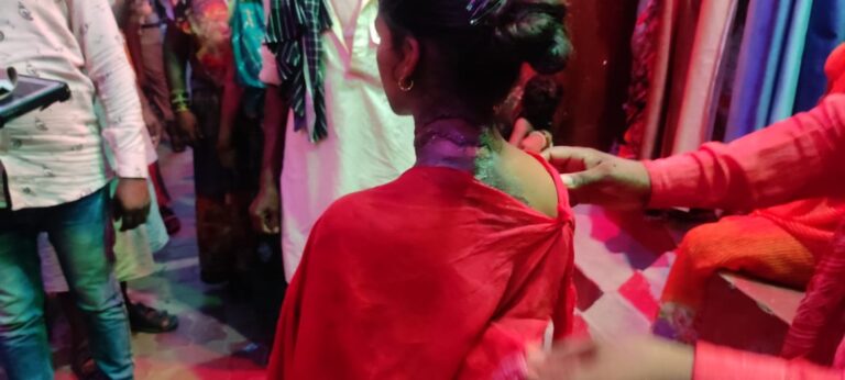 सौतेली मां ने बालिका पर खोलता गर्म चाय फेंका,3 दिन बाद मामले का खुलासा